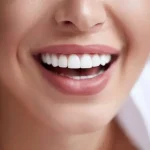 لمینت دندان