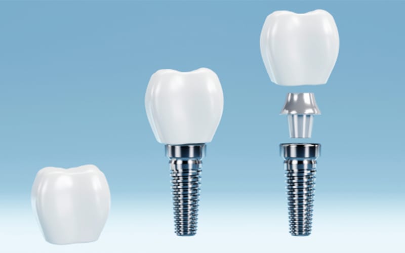 راهکارهای پیشگیری از پوسیدگی  ایمپلنت