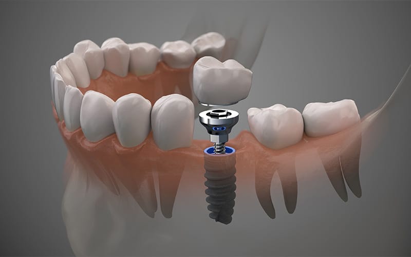 راهکارهای پیشگیری از پوسیدگی  ایمپلنت