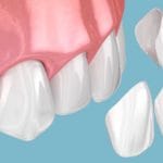 فرق کامپوزیت با کامپوزیت ونیر چیست؟