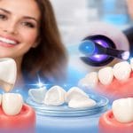 تفاوت لمینت سرامیکی و کامپوزیت ونیر (انتخاب بهترین روش زیبایی دندان)